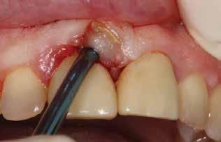 3a 3b Figures 3a, 3b: The untreatable tooth was carefully and