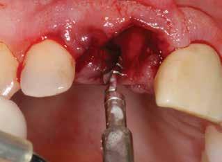 Engaging the palatal wall helps increase initial implant stability.