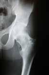 Corrective osteotomy Pathologic