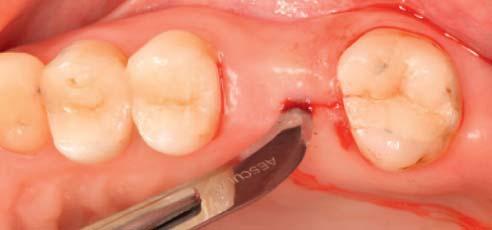 2 1 Condition after tooth extraction due to a