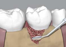 preservation Anterior tooth region 1 x 0.