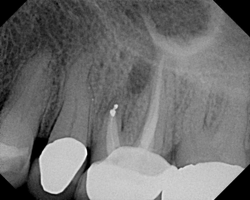 Case #1 of 10 consecutive extraction sockets grafted with Socket Graft Putty, covered with Socket Seal and