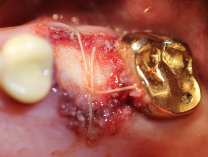 Pre op Failed endodontic treatment with sinus involvement.