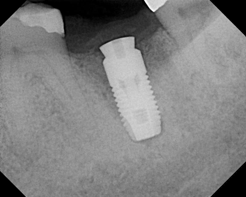 Implant in placed 11 weeks