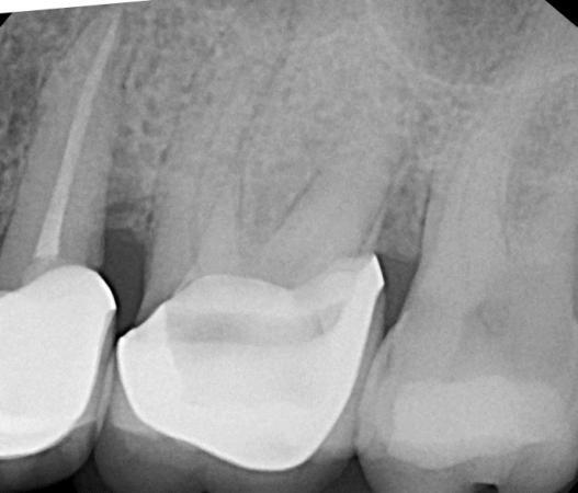 Case DAV Tooth #3 presents with root fracture 13 weeks after