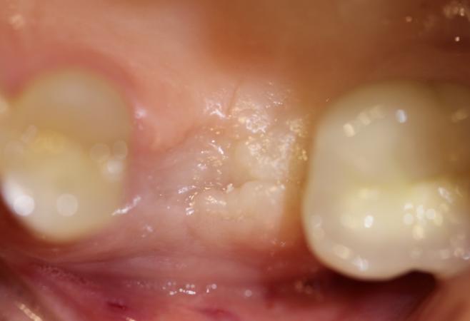 Resorb-X Buccal and lingual walls were injected with Resorb-X