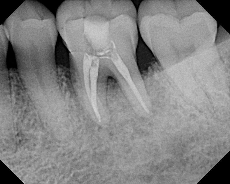 post endodontic therapy Significant