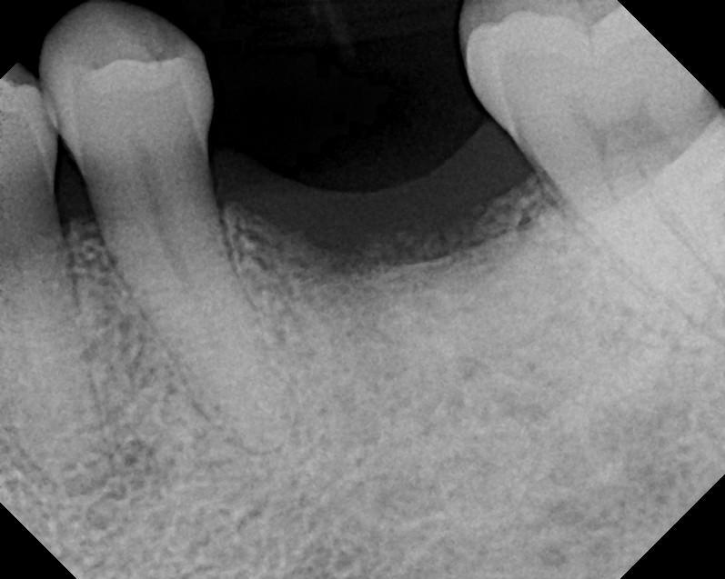 Tooth fracture 8