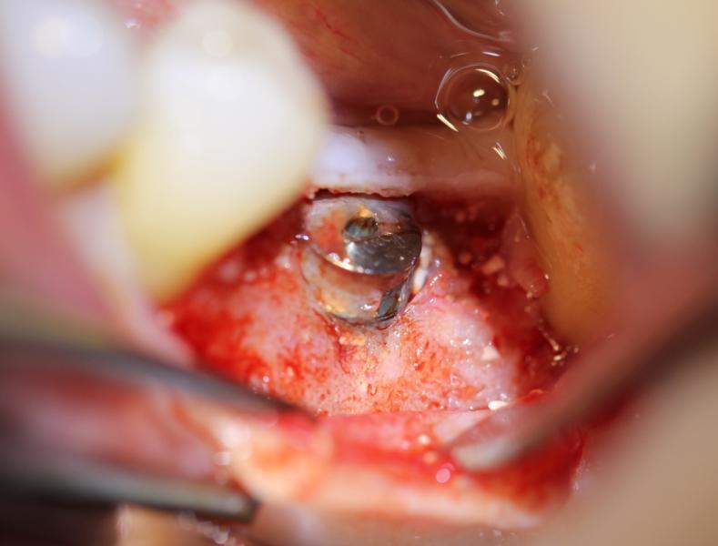 Nine weeks after implant placement and grafting the threads are covered with the exception of the 1 st buccal thread.