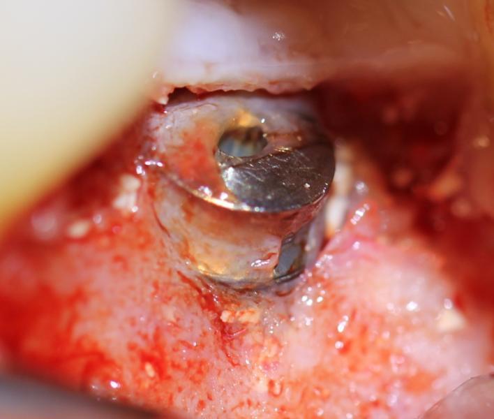 Magnification of crestal regeneration prior to placement of the healing abutment.