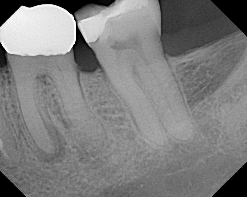 Case ALE This patient was referred for extraction of #19 and implant placement. The extraction was traumatic due to long bulbous roots.