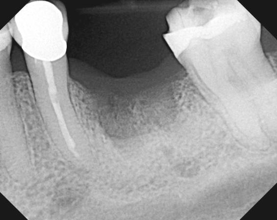 Day of implant placement 10 weeks after extraction and