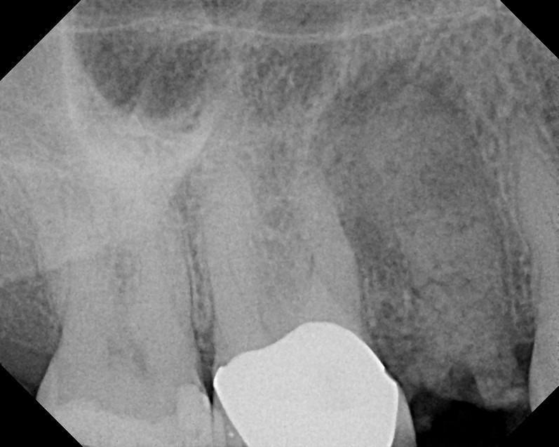 A 76 year old female presents with severe bone loss and mobility The tooth