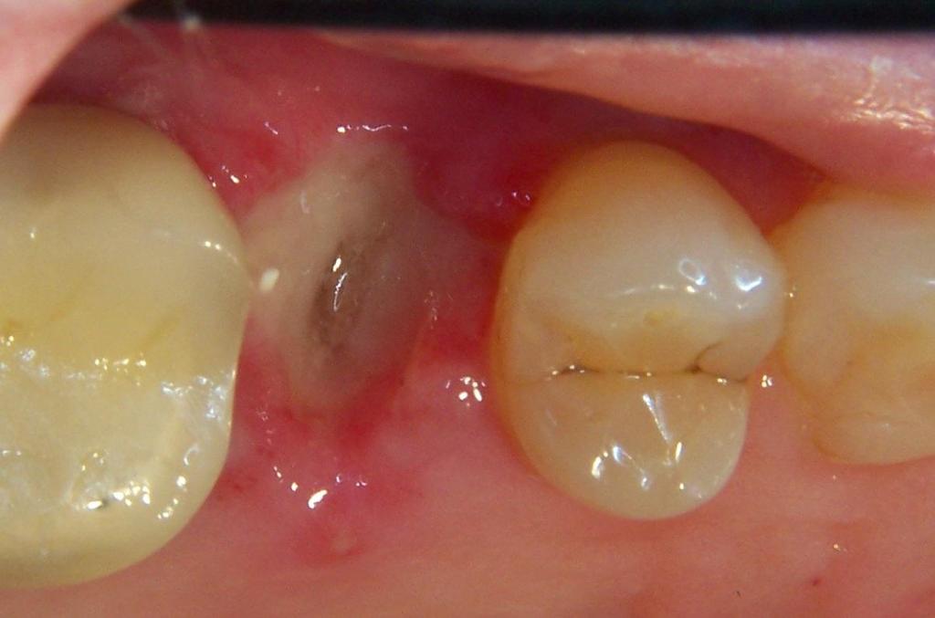 Care was taken to limit the instrumentation of the mesial root of #14.