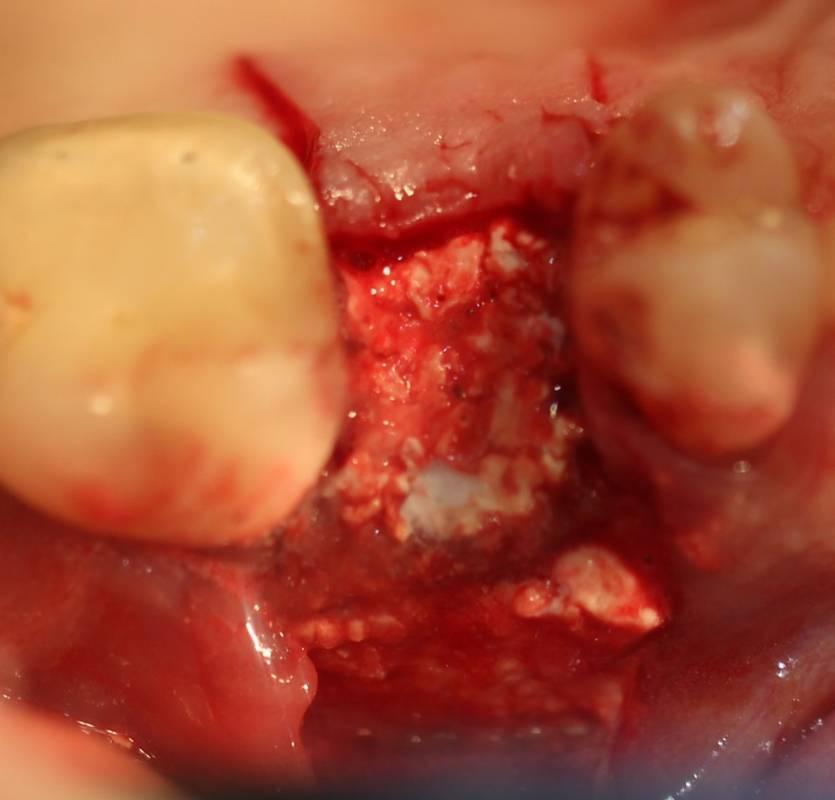 The implant site was grafted with Socket Graft Putty mixed with OsseoConduct Standard BTCP granules.