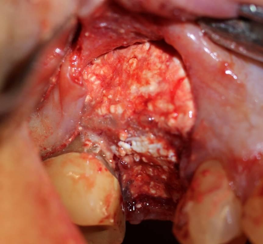 Buccal view of implant site. The implant was placed in the graft material at the time of grafting.