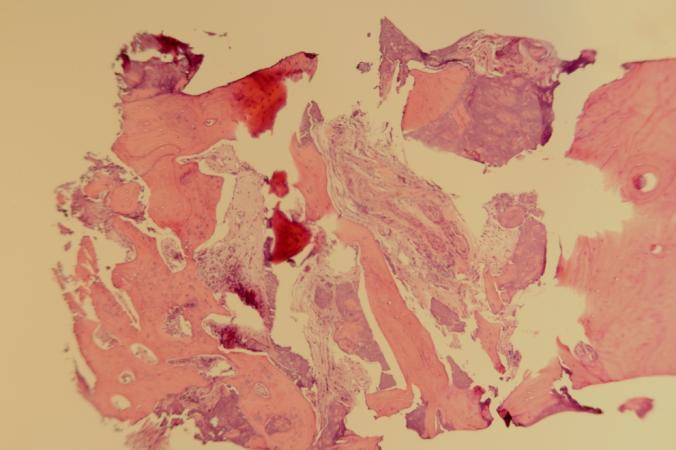 In this histology the core laying on its side with the crest on the left. The crest is densely mineralized with cancellous bone.
