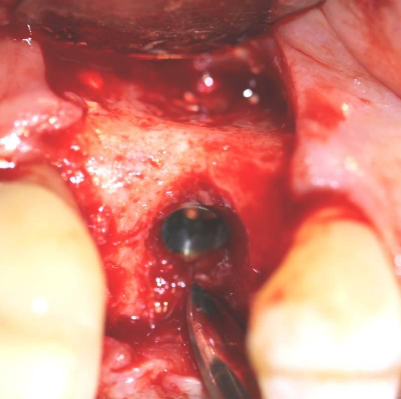 During the time of implant placement the cover screw was unable to be tightened due to the implant floating in graft material
