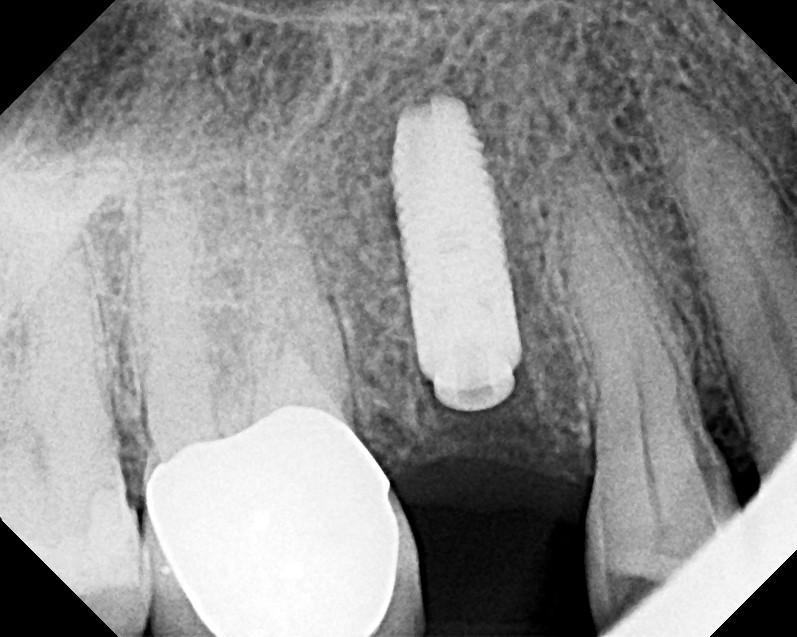 Healing abutment appointment radiograph. This case demonstrates that regenerative therapy will always have occasional failures.