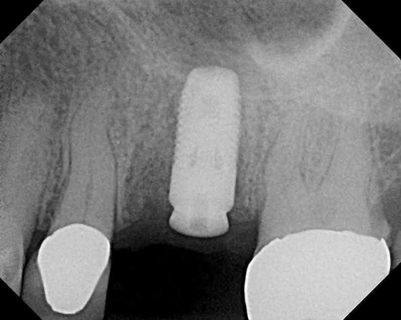 The sinus did not permit for an 11 mm implant.