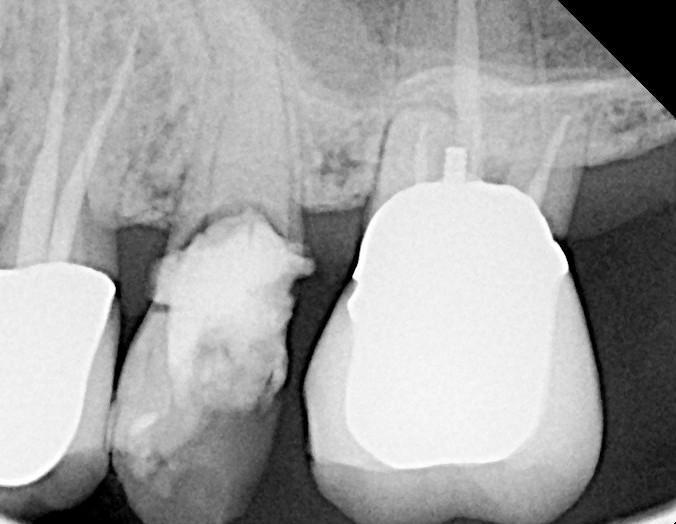 2nd Consecutive Socket Graft Putty with