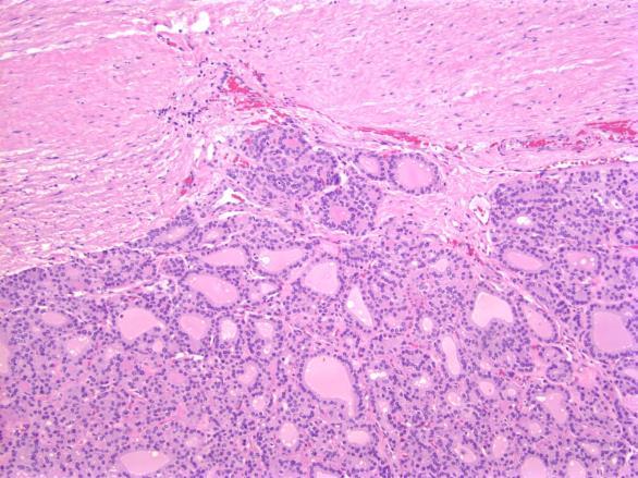 Follicular carcinoma Minimally Invasive, encapsulated By definition: Capsular invasion alone What is capsular invasion?