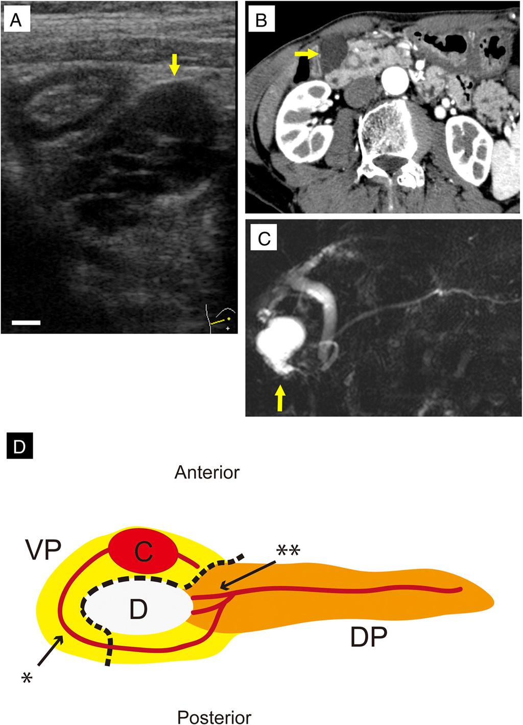 Kobayashi et al. Surgical Case Reports (2015) 1:68 Page 2 of 6 Fig. 1 Diagnostic images of the intraductal papillary mucinous neoplasm (IPMN) in the patient s annular pancreas.