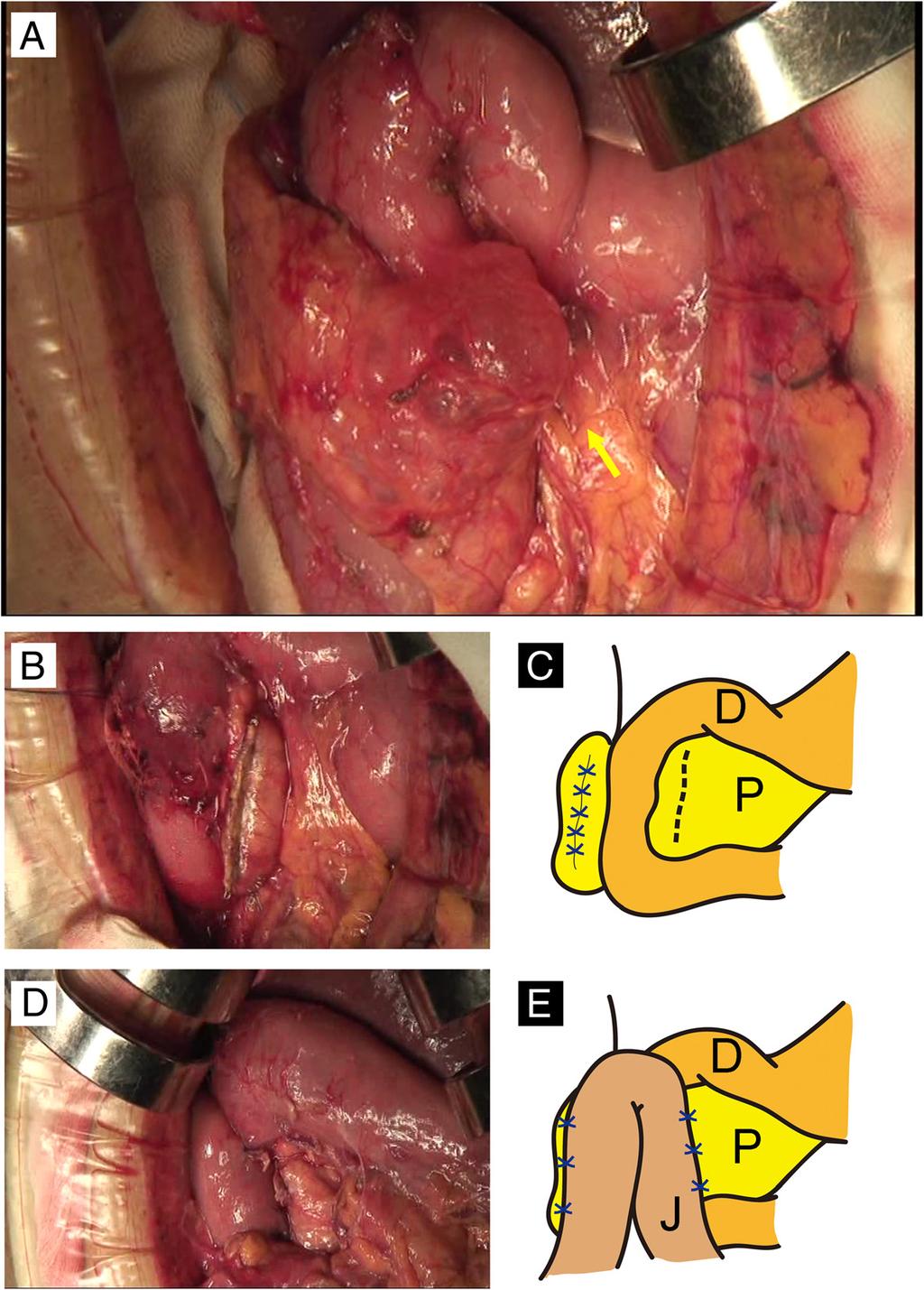 Kobayashi et al. Surgical Case Reports (2015) 1:68 Page 3 of 6 Fig. 2 Limited resection of the annular segment and jejunal patch.