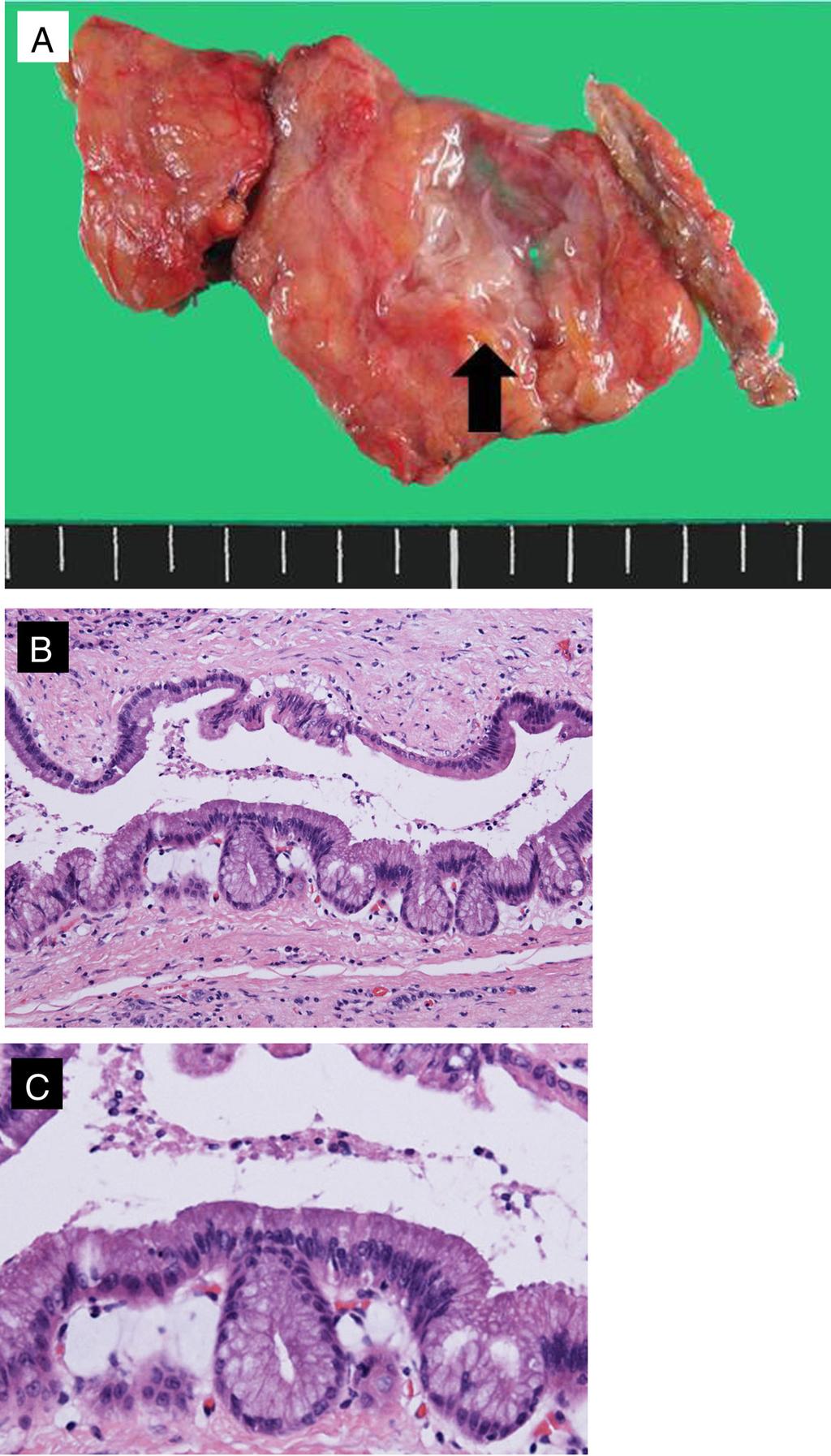 Kobayashi et al. Surgical Case Reports (2015) 1:68 Page 4 of 6 Fig. 3 Histopathological findings. a The resected specimen showed dilatation of the annular pancreatic duct.