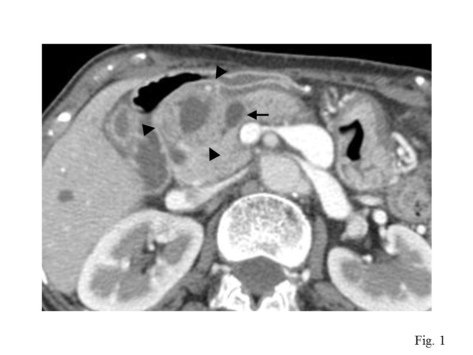 Figure 1. CT scn reveled well enhnced solid tumor with centrl cystic portion (rrowhed) in the hed of the pncres nd dilted pncretic duct of distl side from the tumor (rrow). Figure 2.
