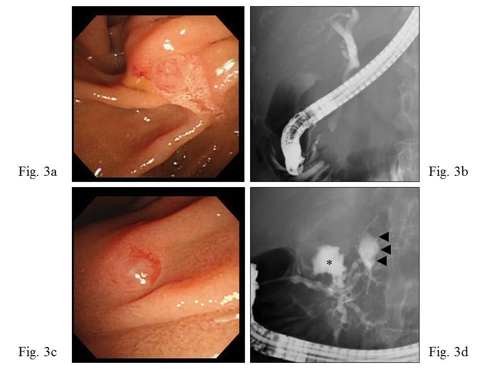 c d Figure 3. (). Endoscopic view of Vter s ppill showed no normlity. (). The duct of Wirsung ws not detected y endoscopic retrogrde cholngiopncretogrphy form Vter s ppill. (c).