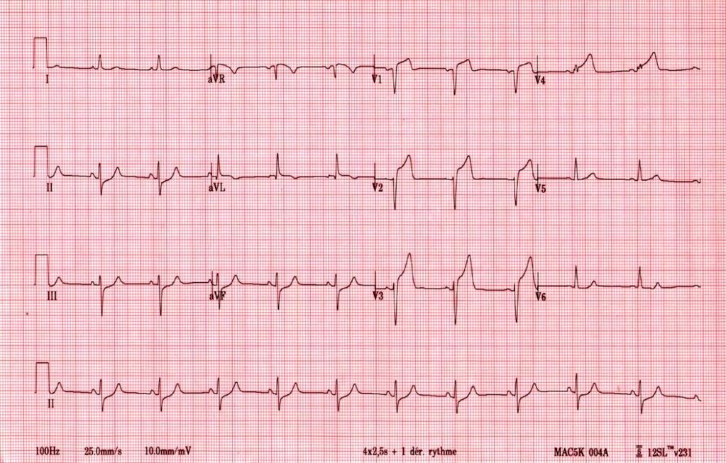 Triaged directly to cath lab Primary PCI - DES in LAD ASA 160 mg/ticagrelor 180 mg Enoxaparin 0.