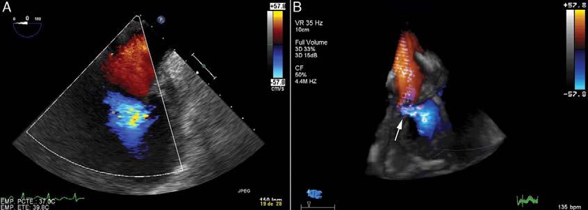 Testing Single most useful test = 2D echo with doppler looking for: LVEF normal or reduced Structural LV abnormalities such