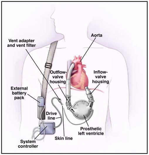 LVAD (left ventricular assist device) Take oxygenated blood from LA or LV go through pump and return to aorta Short or long term use Bridge to