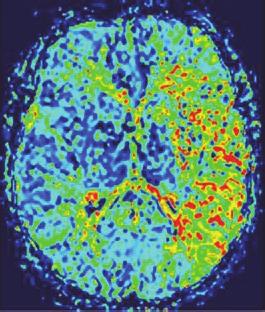magnetic resonance imaging 13 hours after