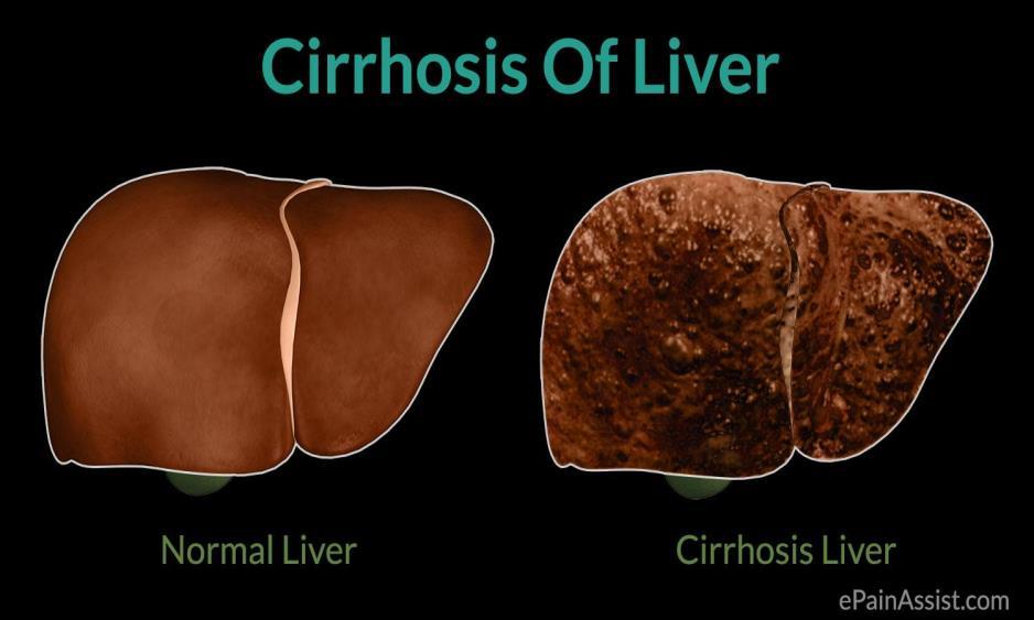 Cirrhosis Late Stage of hepatic fibrosis distortion of hepatic architecture and