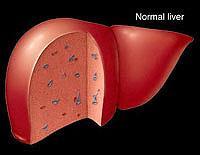 Liver cirrhosis: driver of HCC Healthy liver Liver cirrhosis HCC 1-2% of population Risk factors Hepatitis B: 350 million, 6% of population Hepatitis C: 170