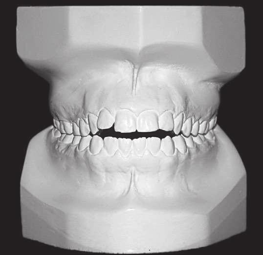BBO Case Report Skeletal and dental Class II malocclusion, with anterior open bite and accentuated overjet Figure 2 - Initial models.