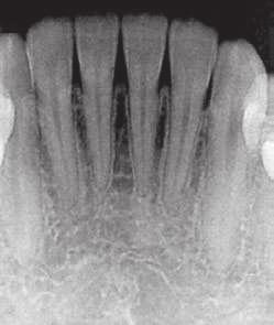 020- in) for alignment and leveling were inserted. In the maxillary arch, the posterior teeth were tied together, on both sides, using 0.018-in wire.