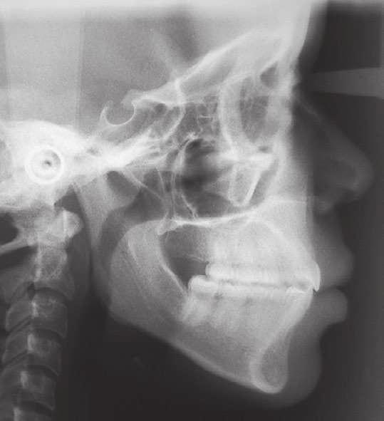 BBO Case Report Skeletal and dental Class II malocclusion, with anterior open bite and accentuated overjet A B Figure 10 - Final cephalometric profile radiographs and cephalometric tracings.