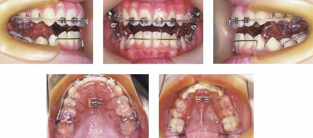 American Journal of Orthodontics and Dentofacial Orthopedics Volume 130, Number 5 Kim, Kim, and Lee 681 Fig 7.
