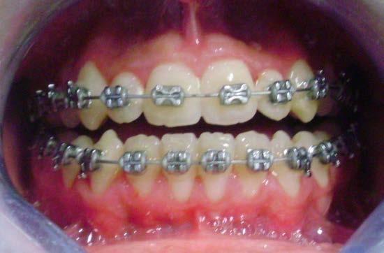 Treatment procedure: Maxillary and mandibular fixed appliances (standard edgewise 0.022-inch) were used. After initial leveling and alignment with round wires in both arches, a 0.016 0.