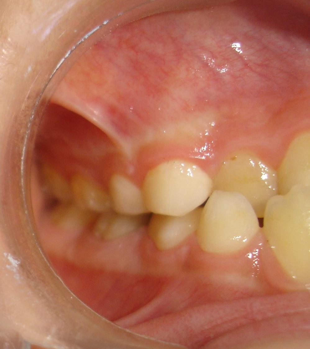 Figure 6. Right side intraoral view. Figure 7. Initial contact between teeth in centric relation.