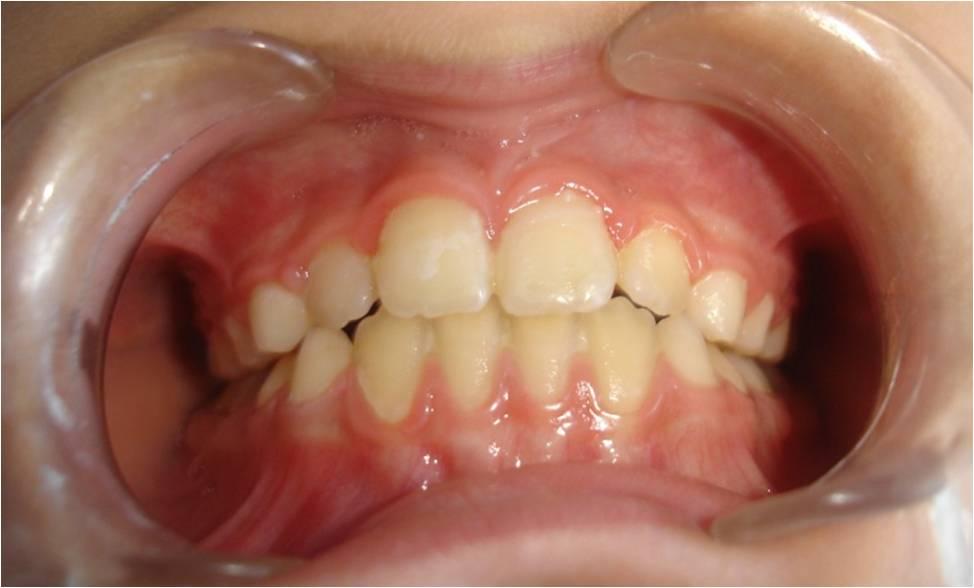 Diagnosis: The clinical examination revealed asymmetrical tapered constricted upper dental arch, moderate crowding,