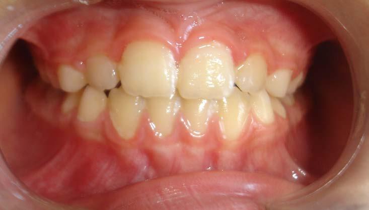 while, lower arch is symmetrical ovoid dental arch, with mild crowding.