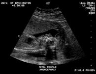 recurrence risk 2% to 3% for woman with a history of a prior pregnancy with an open neural tube defect.