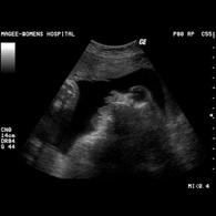 may be detected with ultrasound as early as 10