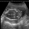 associated findings include Talipes s cleft lip and palate Hypotelorism heart