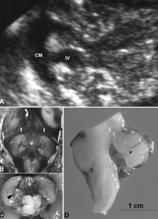Dandy-Walker Malformation Imaging characteristics posterior fossa cyst Splaying of the cerebellar hemispheres enlarged cisterna magna Ventriculomegaly Holoprosencephaly a range of abnormalities