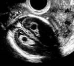 Choroid Plexus Cyst round or ovoid anechoic structures found within the choroid plexus common - identified in approximately 1% of antenatal ultrasound examinations not associated with other anomalies